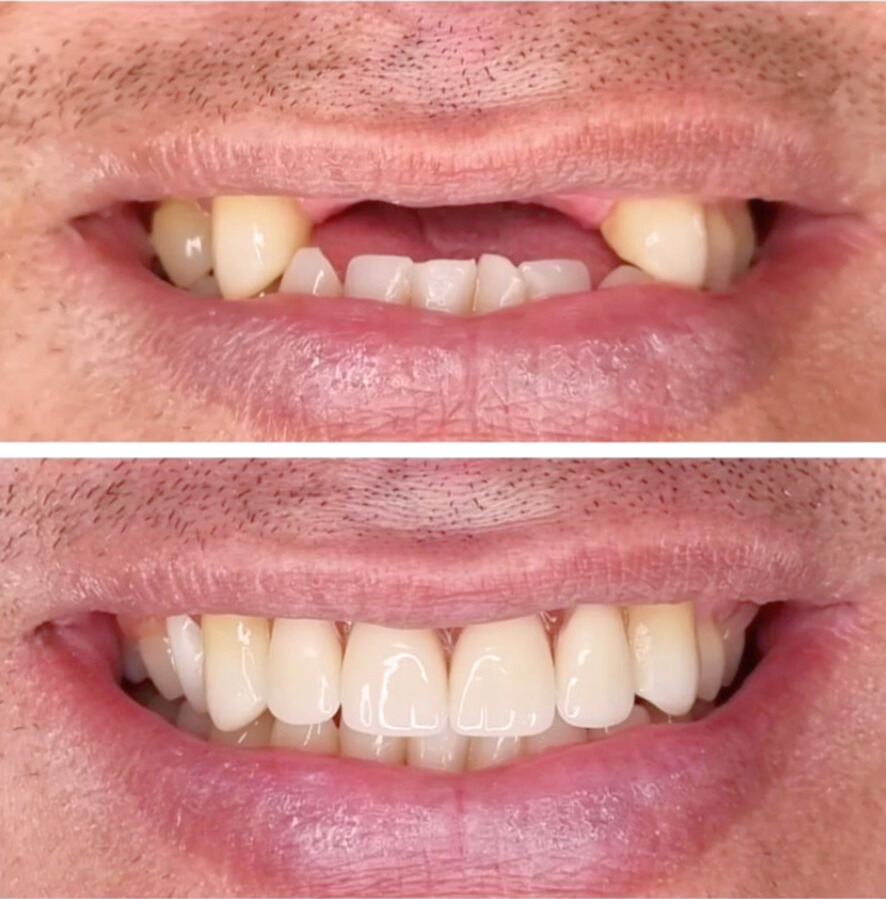 Implantes Dentários